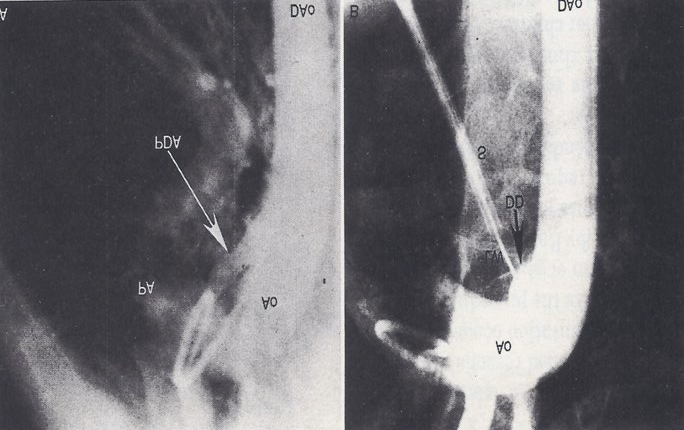 Figure 6: Selected video frames from two-dimensional and color Doppler echocardiographic parasternal short-axis views of the main pulmonary artery (MPA) prior to (a) and following (b) transcatheter buttoned device occlusion of a patent ductus arteriosus (PDA). Note the color flow disturbance indicating a small-to-moderate-sized PDA that is no longer seen in b following transcatheter closure. Forward (blue) flow in the MPA is seen. Also, there is no evidence for obstruction in the main, left (LPA) or right (RPA) pulmonary arteries. Ao, Aorta. Reproduced from Rao PS, et al. [19].