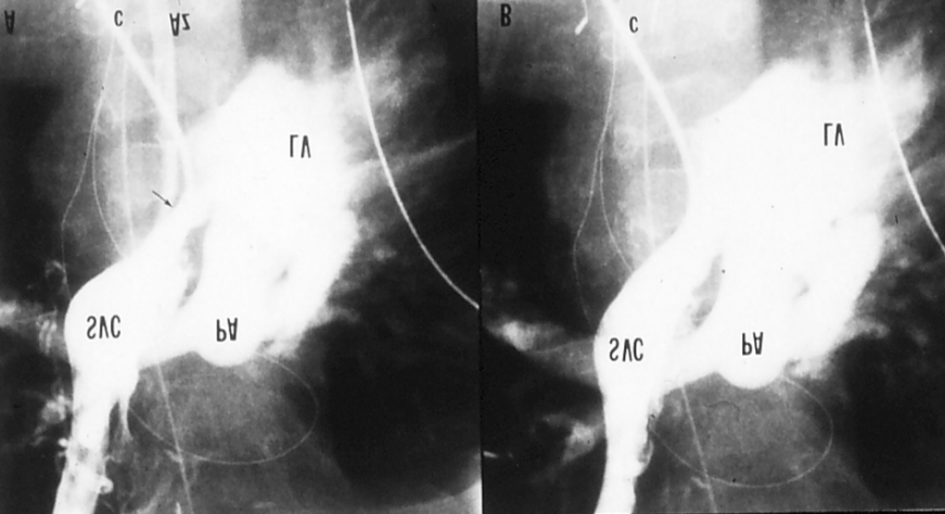 Figure 2: Selected cine frame of a superior vena caval (SVC) angiogram in postero-anterior projection, demonstrating the narrowing (arrow) of the superior limb of the Mustard baffle (A). Note the opacification of the azygos vein (Az) partly decompressing the SVC. This narrowing improved significantly following balloon angioplasty (B). Note that the Az is no longer seen, indirectly indicating the relief of SVC obstruction. c, catheter; LV, left ventricle; PA, pulmonary artery. Reproduced from Rao PS, et al. [7].