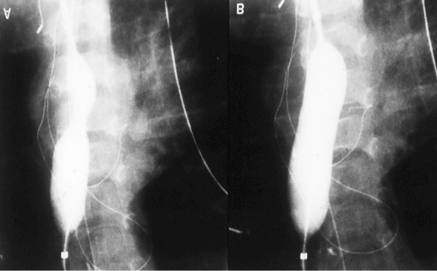 Figure 4: Selected cineradiographic frames of a balloon angioplasty catheter positioned across the narrowed superior limb of the Mustard baffle, demonstrating waisting of the balloon (A) during the initial phases of balloon inflation, which was completely abolished (B) on further inflation of the balloon. No residual waisting was noted during the second and third balloon inflations (not shown). Reproduced from Rao PS, et al. [7].