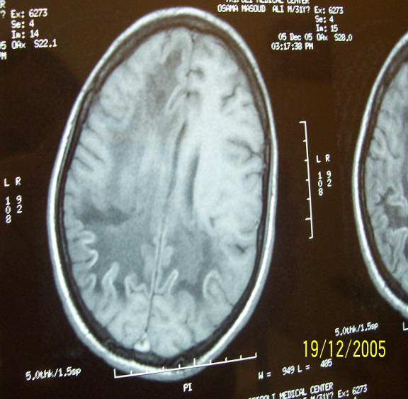 Figure 2: The CT scan appearance of the brain in case 1 showing hypodense area involving the white matter of both cerebral hemispheres more pronounced on the right side.