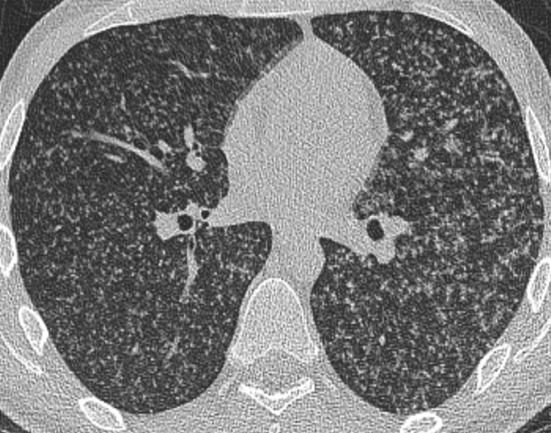 Figure 3: MiIiary tuberculosis. Low dose chest CT showing numerous well defined micronodules with random distribution. Axial coronal.