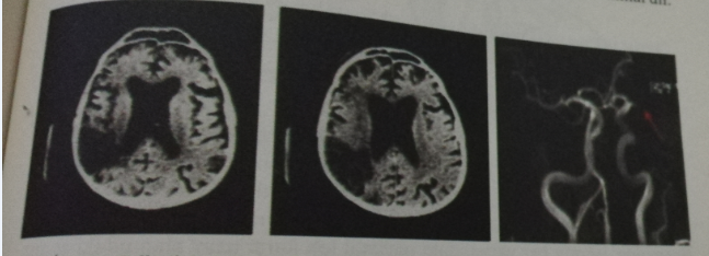 Figure 14: Stroke Suffered by Federico Fellini [8].