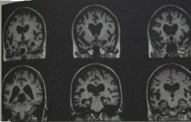 Figure 17: MRI on Temple Grandin [40].