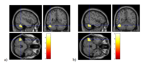 Figure 5: a) Gray matter volume has a significantly positive relationship with drawing accuracy: b) Gray matter volume is significantly positively correlated with cluster-level drawing accuracy [10].