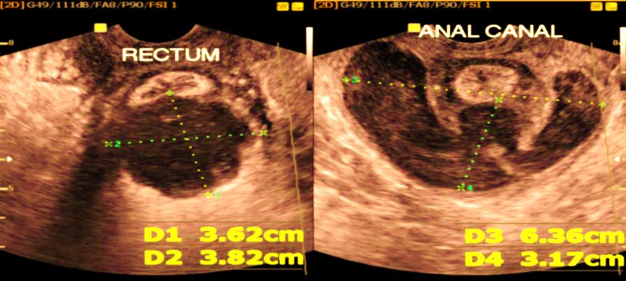 Figure 1: 2 dimmensional endovaginal ultrasound showing large posterior horse-shoe intersphincteric abscess seen extending from mid anal canal to the posterior rectal wall.
