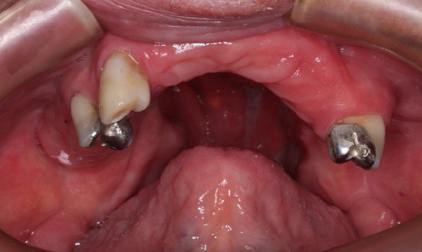 Figure 1: Intraoral view of oronasal communication in maxilla, soft palate, tonsil and oropharynx. Intraoral view of mandible.