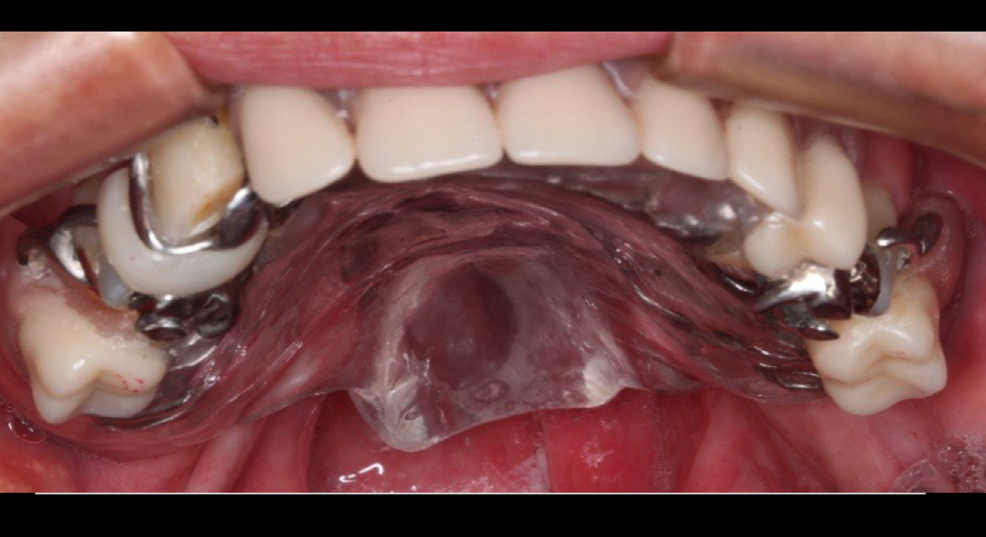 Figure 4: Prosthesis after installation.