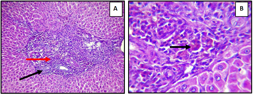 Figure 1: Liver of adult male rat treated with Sodium Molybdate 50 mg/Kg/B.W for day 60, showing (A) infiltration of mononuclear cells ( ) (H &E 10X). And (B) moderate hemosidrosis (