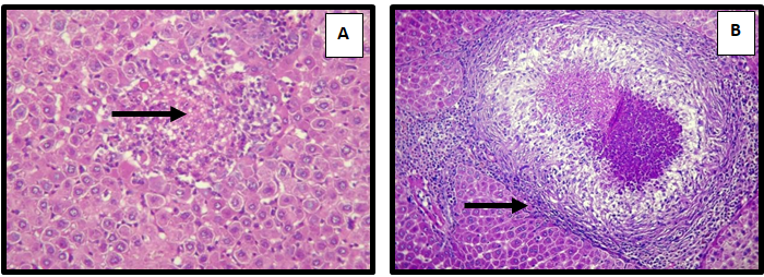 Figure 3: Liver of adult male rat treated with Sodium sulfate 500 mg/Kg/B.W for 60 days, showing (A) focal area of necrosis ( ) (H&E 40X). And (B) suppurative granuloma ( ) (H&E 10X).