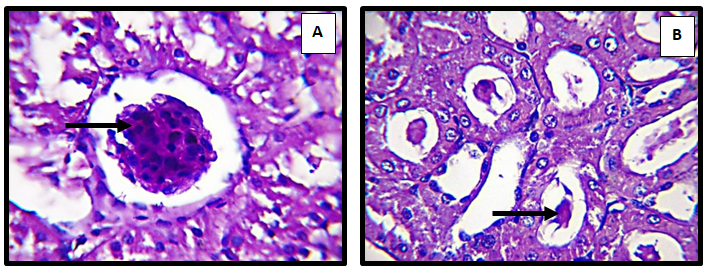 Figure 4: kidney of adult male rat treated with Sodium sulfate 500 mg/Kg/B.W at 60 days, showing (A) atrophy of glomerular tuft ( ) (H&E 60X). And (B) cystic diltation of cortical renal tubules with deposition of hyaline cast (