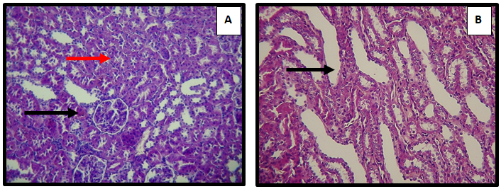 Figure 6: Kidney of adult male rat treated with sodium molybdate 50 mg/Kg/B.W and Sodium sulfate 500 mg/Kg/B.W (combination) for 60 day, showing (A) acute cellular swelling of proximal and distal convoluted tubules ( ) with mild hemosidrosis ( ) (H&E 10X). And (B) cystic dilatation of medullary renal tubules (