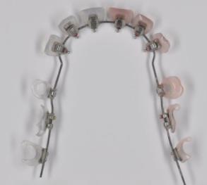 Figure 1: GC Kommonbase customized bracket bases with resin extensions. Teeth are etched, rinsed and dried and clinical bonding is accomplished with light curable resin-modified glass ionomer cement. The advantage of using RGIC is that the bond strength of an RGIC is not affected in moist condition in situations where brackets are bonded in close proximity to gingival tissue [4-6].