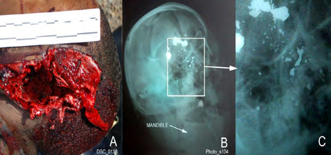 Figure 1: A. Image of the left side of the victim’s head showing the massive defect caused by the 12 gauge shotgun’s discharge; the autopsy report determined this is the entrance wound [2]. B. LL projection X-ray of the victim’s head shows lead projectiles; one of the shotgun pellets is at the victim’s upper jaw, overlapping his teeth. C. Enlargement of the area within the rectangle in B show numerous fine particles from lead shot fragmentation.