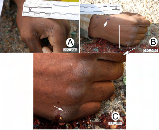 Figure 10: A. Left hand of the victim; the hand was in contact with the road pavement where it picked up dirt. B. Right hand of the victim; the bloodstain at arrow has dirt associated. Arrow points to dirt associated with bloodspatter. C. An enlargement of the outlined area in B, which shows the victim’s knuckles were abraded; a small amount of skin was more deeply abraded at the arrow.