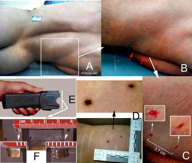 Figure 11: Wound evidence of the stun gun used in the victim’s attack. A. Two small wounds were on the victim’s right lateral mid-lumbar posterior torso skin. B. Enlargement of the area in the square in A; image was color adjusted by Photoshop/Image/ Adjustments/Hue/Saturation to accentuate the halo of hyperemia about 10 cm from the wounds. C. Additional enlargement of this wound area reveals the two wounds have different shapes. D. Similar wounds were attributed to a stun gun in the1996 JonBenet Ramsey homicide case; images downloaded from the Internet via Google. E. The Air Taser 34000 without its taser dart projection module; this Taser model ceased production in 1998 [20]. F. The Air Taser 34000 face without its taser module showing its electrodes; the two electrodes are flat, copper or copper plated tabs (image from [21]). The right electrode (inset) was forcibly lifted, breaking away part of the electrode housing (note scratch marks), likely to achieve better skin contact, thus converting the taser into a stun gun. The two electrode central distance between the two was approximately 3.7 cm.