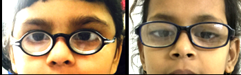 Figure 2: Two siblings (pedigree 16 and 17) from 3rd generation presented high hypermetropia with bilateral ectopia lentis. Subluxation corrected by aphakic lens.