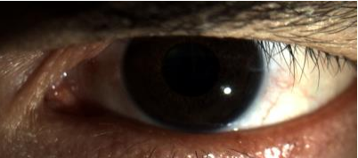 Figure 10: LE no red eyes, vascularization or lens injunction.