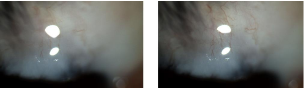 Figure 8: LE bulge.