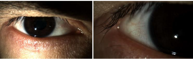 Figure 9: RE no red eyes, vascularization or lens injunction.