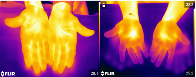 Figure 10: Thermal imaging of blood circulation in the palms of diabetic patients. (Courtesy: Gayathri Choda and Rao GHR: J/ Clin Cardiol & Diagnostics 3(1), 2020).