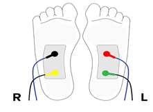 Figure 14: Sudomotor Dysfunction Studies (Courtesy: Albert Maarek. LD Technologies, Miami, Florida).