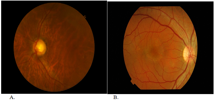 Figure 9: Photographs of eyes of diabetic subjects (Courtesy: Shyam Vasudeva Rao, Renalyx Health systems, Bengaluru, India).