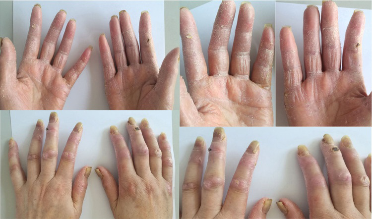 Figure 1: Severe hand-foot syndrome in the patient after the fourth cycle of chemotherapy, with loss of fingerprints, peeling of skin, blidters, chapping & scabbing in some area.