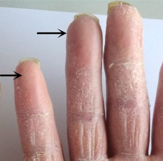 Figure 5: Location of loss of fingerprint as a side effect of use of capecitabine.