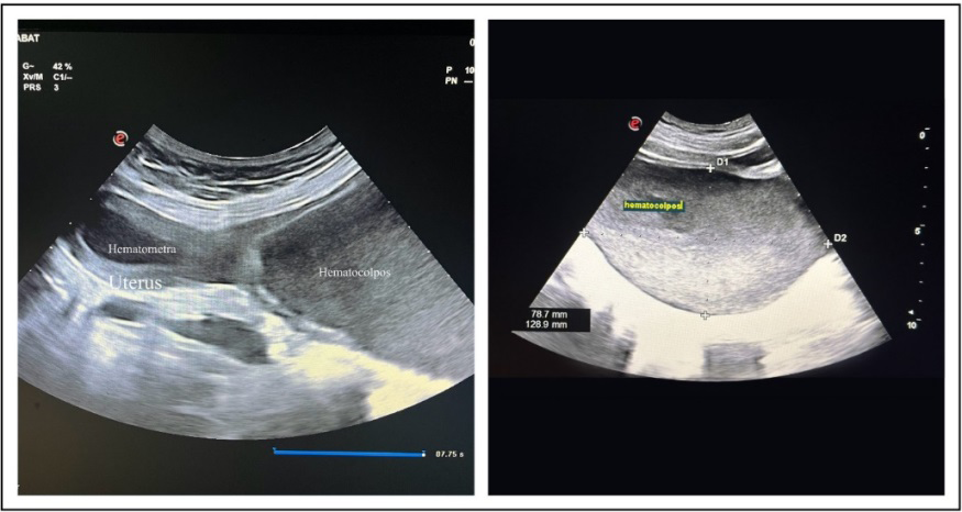 Figure 2: Transabdominal ultrasound image showing hematocolpos and hematometra.
