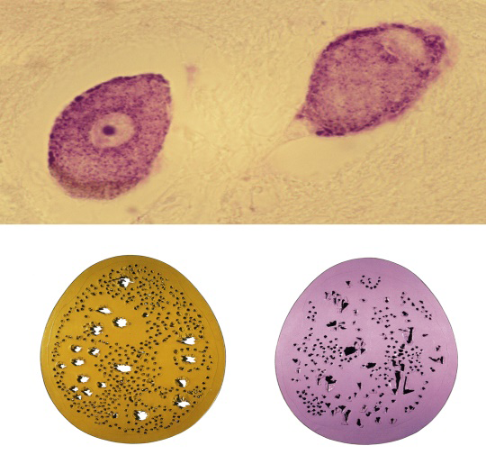 Figure 10: Two ganglion cells of the mesencephalic trigeminal nucleus (top) (Nissl-stained and magnified × 400), similar in appearance to the artwork by Lucio Fontana’s Spatial Concept“ (bottom). (Courtesy of Kupferstichkabinet, Staatliche Museen zu Berlin).