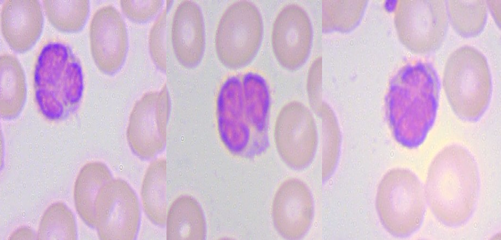 Figure 1: Peripheral blood smear from Case #1 before starting chemotherapy, showing atypical lymphocytes with cleaved and convoluted nuclei consistent with “flower cells.”