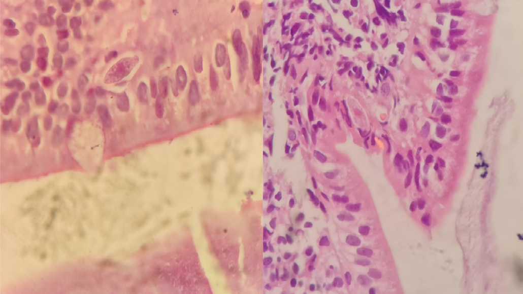 Figure 2: Duodenum biopsy showing Cystoisospora belli from Case #2 - Previous admission.