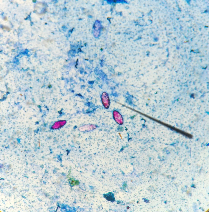Figure 3: Cystoisospora belli in a stool sample with modified-acid fast staining from Case #2 - Current admission.