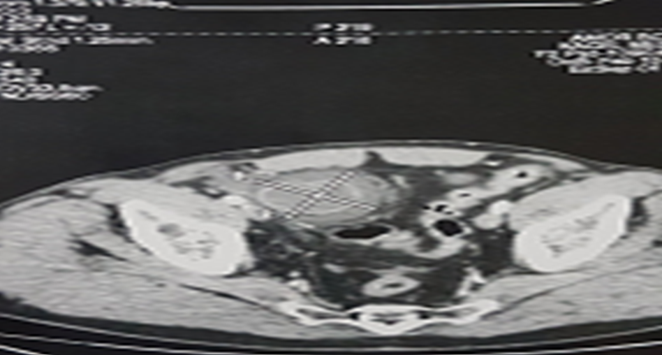 Figure 5: CT Image of a Supravesical Internal Hernia (Cross Section).