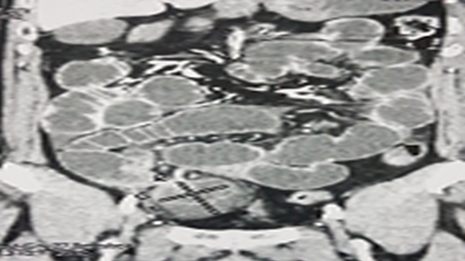 Figure 6: CT Image of a Supravesical Internal Hernia (Frontal Section).
