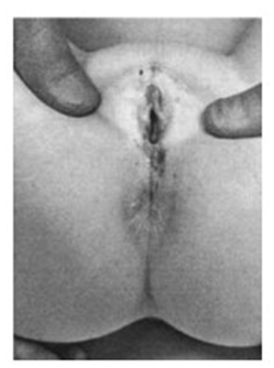 Figure 1: Pre-pubertal lichen sclerosus – at the age of 5. Note the well demarcated whitening, rubbery oedema of labia minora and purpura. Such changes can be mistakenly taken as evidence of sexual abuse. Note fissuring around the anal canal. This causes painful defaecation and hence retention so that constipation is a frequent presenting symptom in girls.