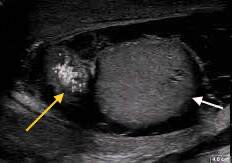 Figure 1: The scrotal ultrasound demonstrated a normal left testis with normal size, shape, and echogenicity (white arrow). There was an extra-testicular mass distinctly separated from the ipsilateral testis with scattered calcification (yellow arrow). Small hydrocele was also present.
