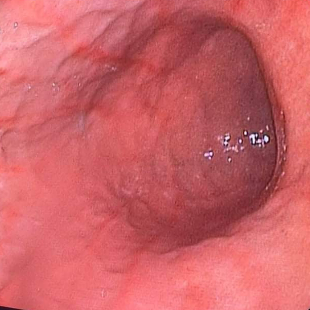 Figure 1: Direct vision gastroscopy showing erythematous and linear gastric mucosa at the antral level.