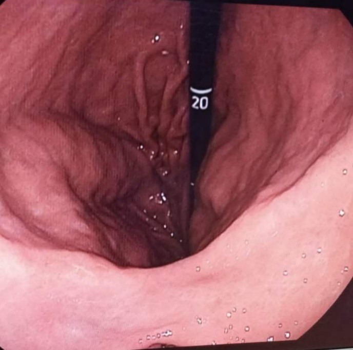 Figure 4: Retro vision gastroscopy showing a normal looking gastric mucosa.