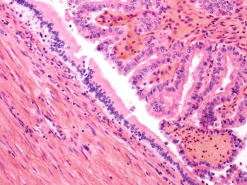Figure 2: Intraductal papillary neoplasm of bile duct delineating micro-papillary articulations with a distinct fibro-vascular core layered by intestinal epithelium with minimal cytological atypia [6].