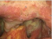 Figure 1: Infiltrative lesion with edema, hyperemia and purulent discharge in the uvula, soft palate and oropharynx.