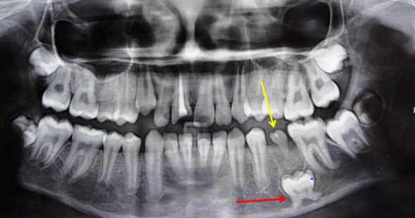 Figure 1: Orthopantomograph showing severe impaction of primary mandibular left second molar (red arrow). Malformed erupted second premolar can be observed (yellow arrow).