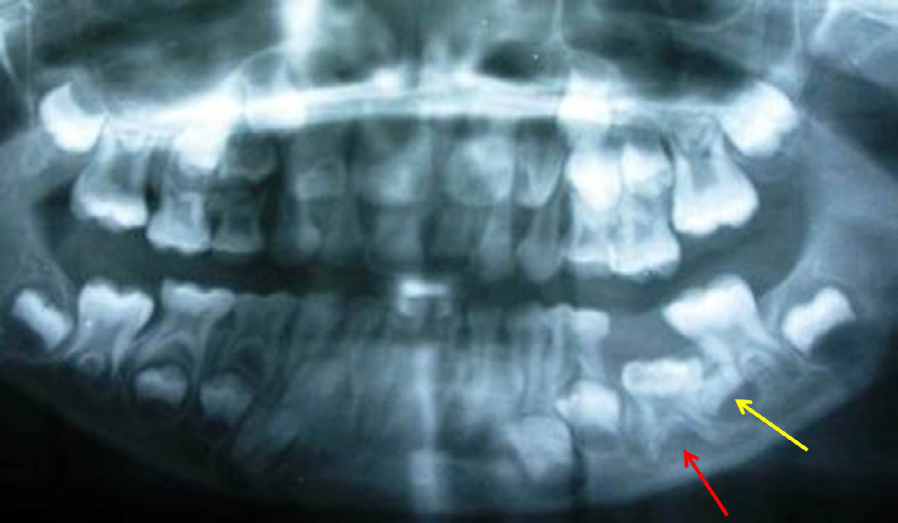 Figure 2: Radiograph showing impacted primary mandibular left second molar (red arrow). Developing second premolar tooth bud is drifted distal to primary second molar (yellow arrow).