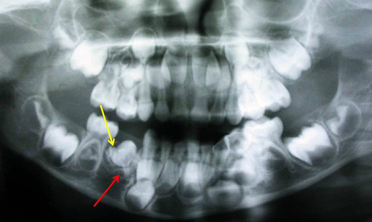 Figure 3: Radiograph showing distally impacted primary mandibular right first molar (red arrow). Odontoma like radiopaque structure with agenesis of first premolar can be noticed associated with impacted primary molar (yellow arrow).