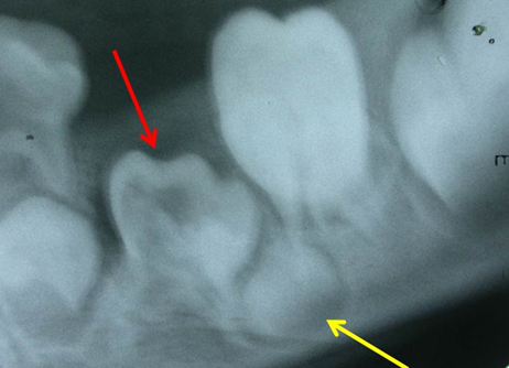 Figure 5: Radiograph showing impacted primary mandibular left second premolar (red arrow). Distally drifted second premolar tooth bud can be seen (yellow arrow).