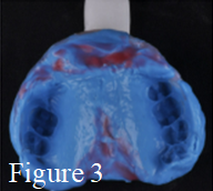 Figure 4: Metal frame in the upper plaster model.