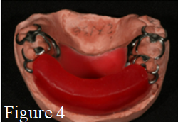 Figure 5: Prove of removable partial denture metal frame and upper wax plane in the mouth, registration of reference lines.