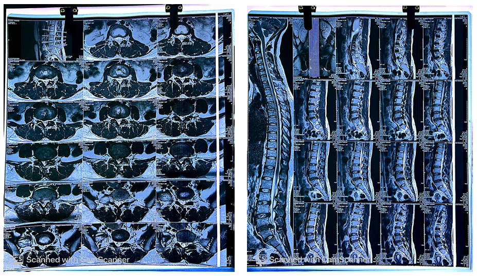 Figure 2: MRI Scan of Lumbar Spine.
