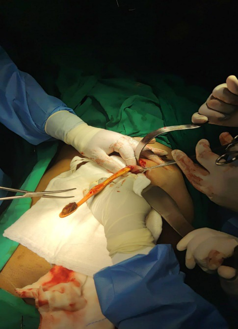Figure 2: Showing removed Tooth Brush.