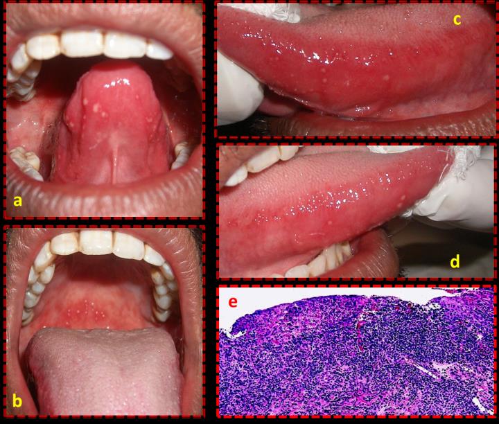 Figure 1: Multiple ulceration at various locations within the oral cavity (a-e). Severe inflammatory cellular infiltration accompanied with ulceration in form of epithelial degeneration.